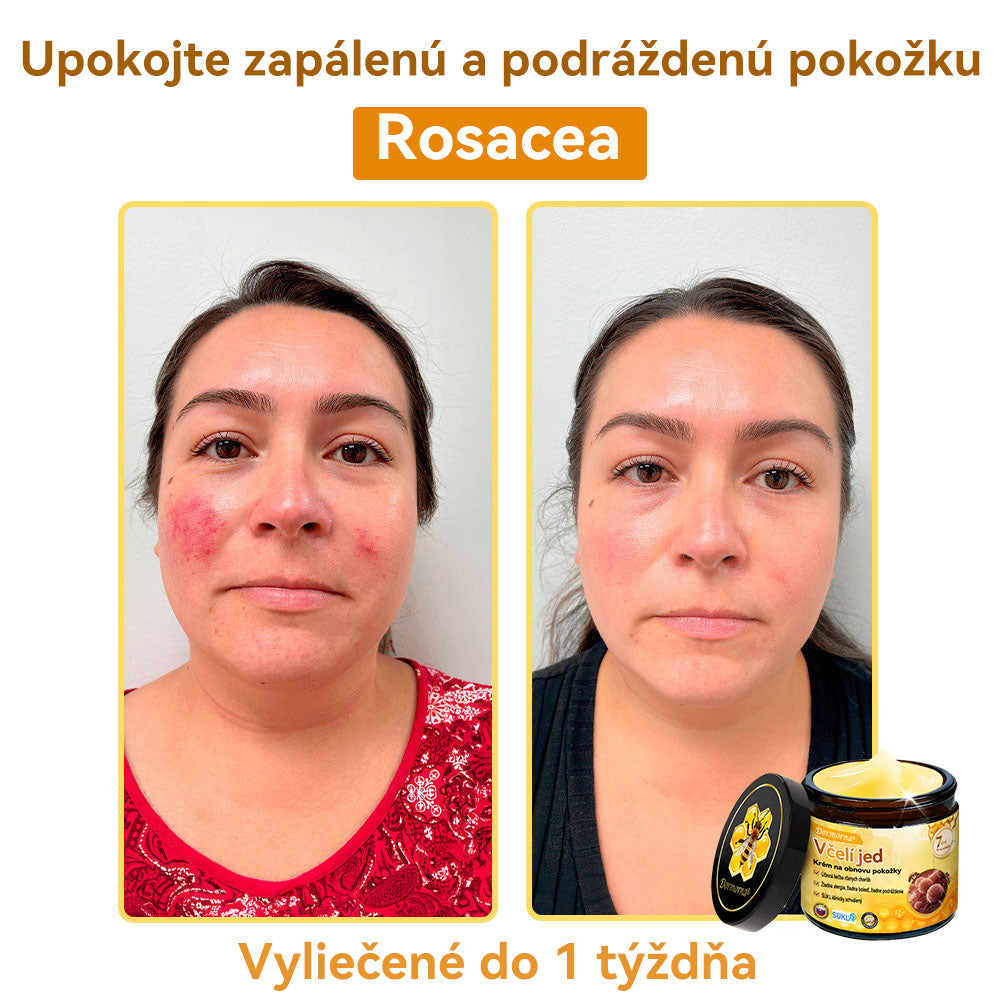 [💯 Bez bolesti-bez vedľajších účinkov] 𝐃𝐨𝐫𝐦𝐨𝐫𝐧𝐚®💥💥𝐕č𝐞𝐥í 𝐣𝐞𝐝 𝐊𝐫é𝐦 𝐧𝐚 𝐨𝐛𝐧𝐨𝐯𝐮 𝐩𝐨𝐤𝐨ž𝐤𝐲- POSLEDNÝ DEŇ 70% VYPNUTIE