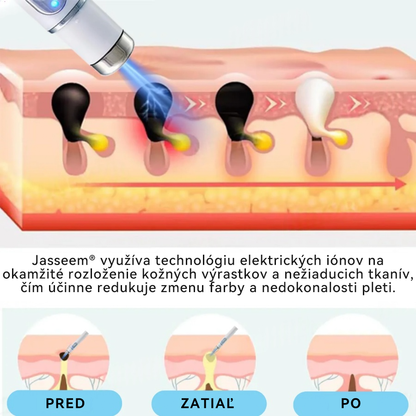 𝐉𝐚𝐬𝐬𝐞𝐞𝐦® Laserové pero medicínskej kvality 💕 (Poháňané CO₂ laserovou technológiou – účinne odstraňuje znamienka, bradavice, kožné výrastky, pigmentové škvrny a iné nedokonalosti pokožky) 🔥