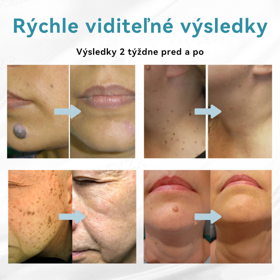 𝐉𝐚𝐬𝐬𝐞𝐞𝐦® Laserové pero medicínskej kvality 💕 (Poháňané CO₂ laserovou technológiou – účinne odstraňuje znamienka, bradavice, kožné výrastky, pigmentové škvrny a iné nedokonalosti pokožky) 🔥
