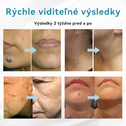 𝐉𝐚𝐬𝐬𝐞𝐞𝐦® Laserové pero medicínskej kvality 💕 (Poháňané CO₂ laserovou technológiou – účinne odstraňuje znamienka, bradavice, kožné výrastky, pigmentové škvrny a iné nedokonalosti pokožky) 🔥