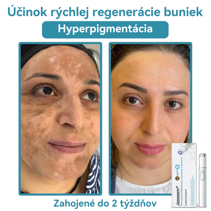 𝐉𝐚𝐬𝐬𝐞𝐞𝐦® Laserové pero medicínskej kvality 💕 (Poháňané CO₂ laserovou technológiou – účinne odstraňuje znamienka, bradavice, kožné výrastky, pigmentové škvrny a iné nedokonalosti pokožky) 🔥