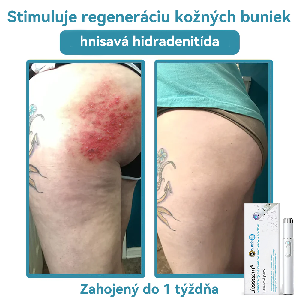𝐉𝐚𝐬𝐬𝐞𝐞𝐦® Laserové pero medicínskej kvality 💕 (Poháňané CO₂ laserovou technológiou – účinne odstraňuje znamienka, bradavice, kožné výrastky, pigmentové škvrny a iné nedokonalosti pokožky) 🔥