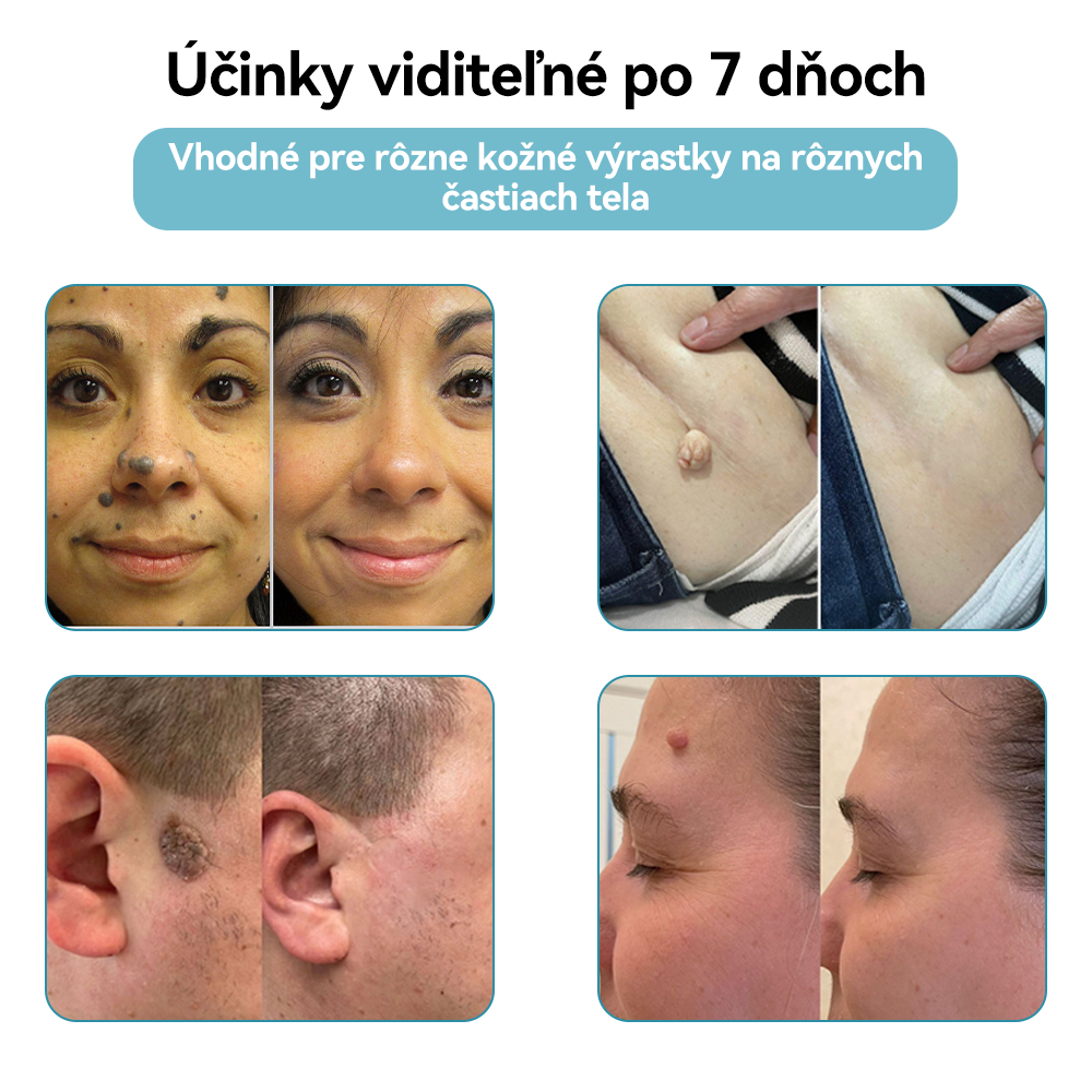 𝐉𝐚𝐬𝐬𝐞𝐞𝐦® Laserové pero medicínskej kvality 💕 (Poháňané CO₂ laserovou technológiou – účinne odstraňuje znamienka, bradavice, kožné výrastky, pigmentové škvrny a iné nedokonalosti pokožky) 🔥