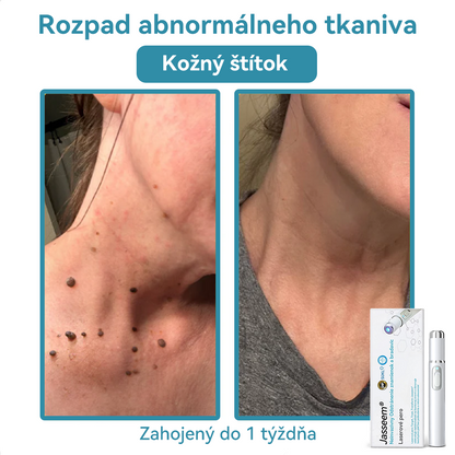 𝐉𝐚𝐬𝐬𝐞𝐞𝐦® Laserové pero medicínskej kvality 💕 (Poháňané CO₂ laserovou technológiou – účinne odstraňuje znamienka, bradavice, kožné výrastky, pigmentové škvrny a iné nedokonalosti pokožky) 🔥