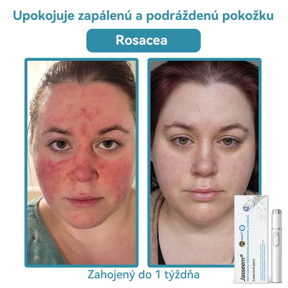 𝐉𝐚𝐬𝐬𝐞𝐞𝐦® Laserové pero medicínskej kvality 💕 (Poháňané CO₂ laserovou technológiou – účinne odstraňuje znamienka, bradavice, kožné výrastky, pigmentové škvrny a iné nedokonalosti pokožky) 🔥